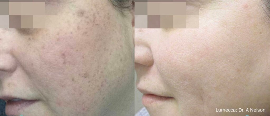 lumecca in Columbus Ohio ipl laser near me