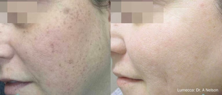 lumecca in Columbus Ohio ipl laser near me