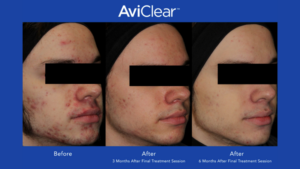 laser acne treatment in columbus ohio