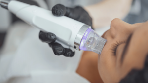 RF Microneedling in Columbus Ohio