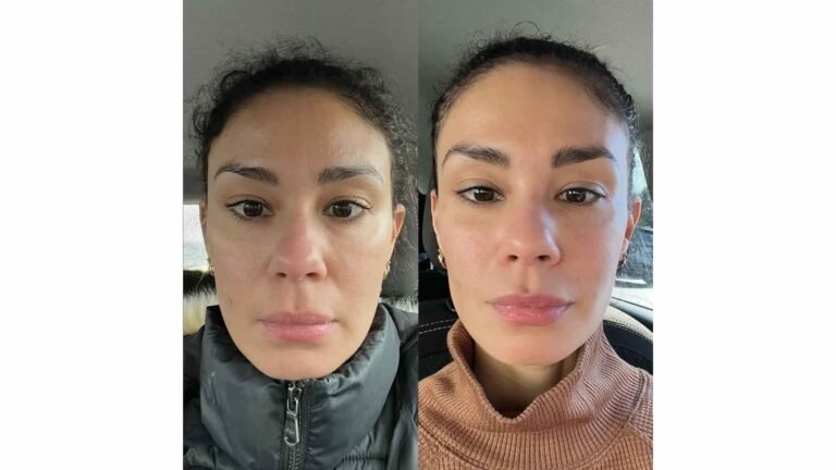 facial balancing near me in columbus ohio. facial balancing results by reverse aesthetics.
