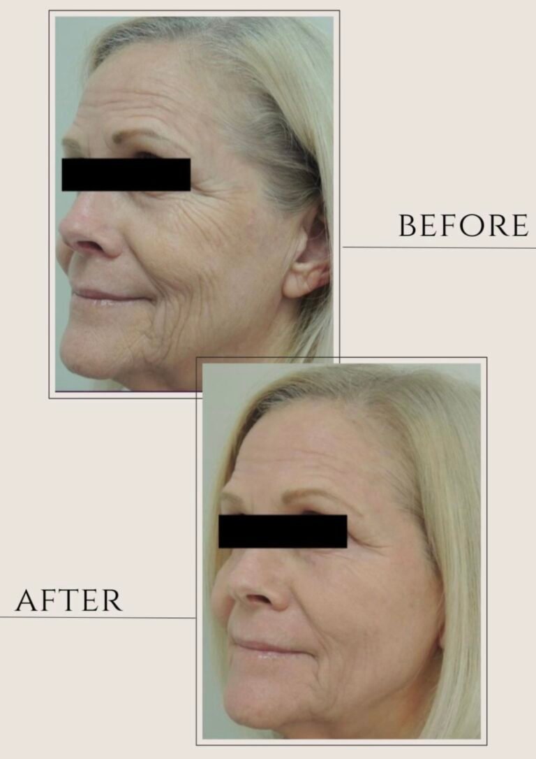 CO2 Laser Skin Resurfacing near me