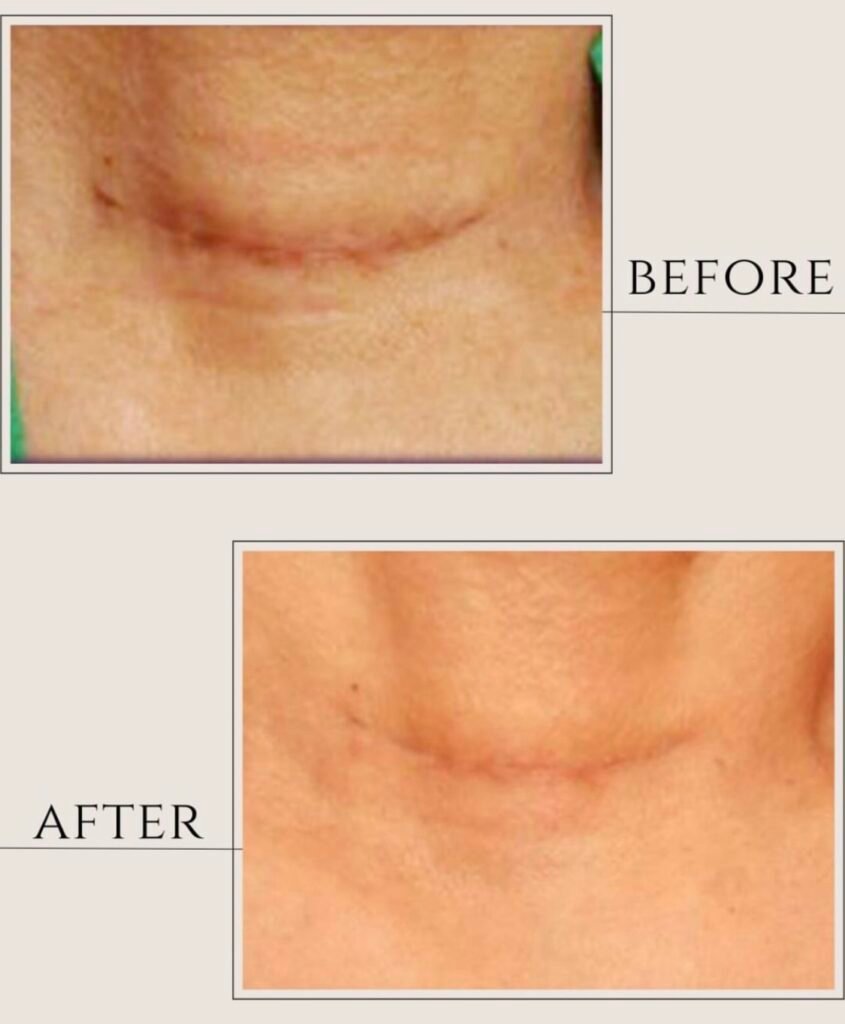 skin resurfacing treatment near me