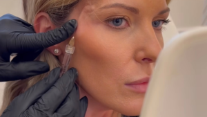 temple filler being injected in Columbus, Ohio by Reverse Aesthetics